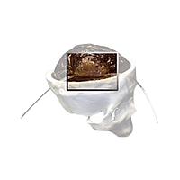 Mô hình tụ máu True Phantom Solutions HA-A01